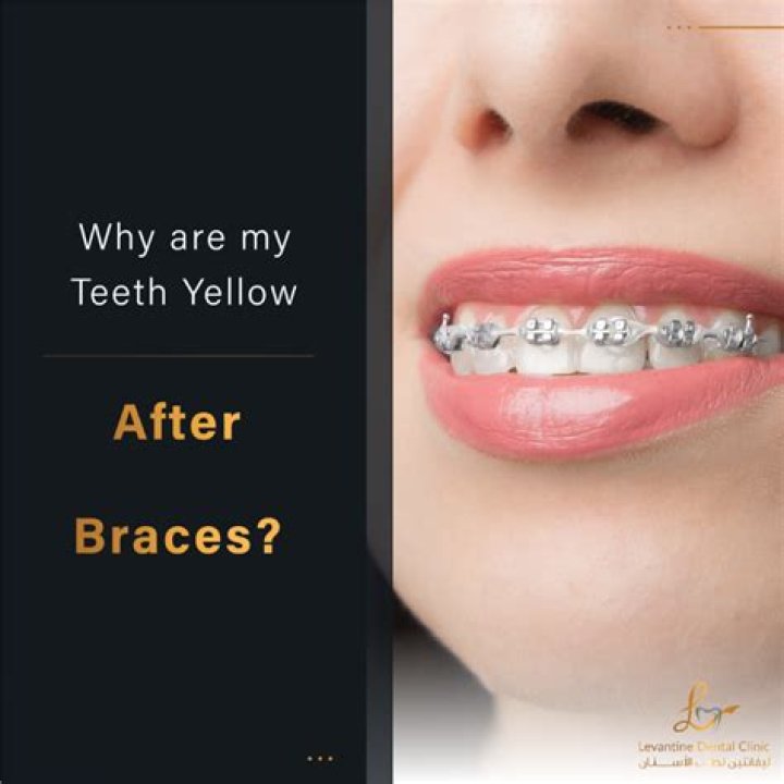 Are teeth yellow after braces?