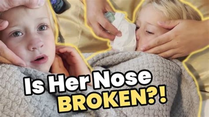 Can a 2 year old break their nose?