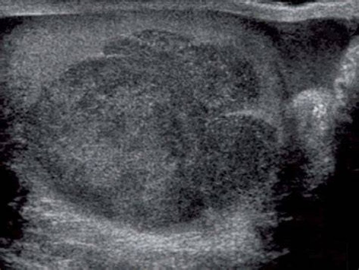 Can a tumor be missed on ultrasound?