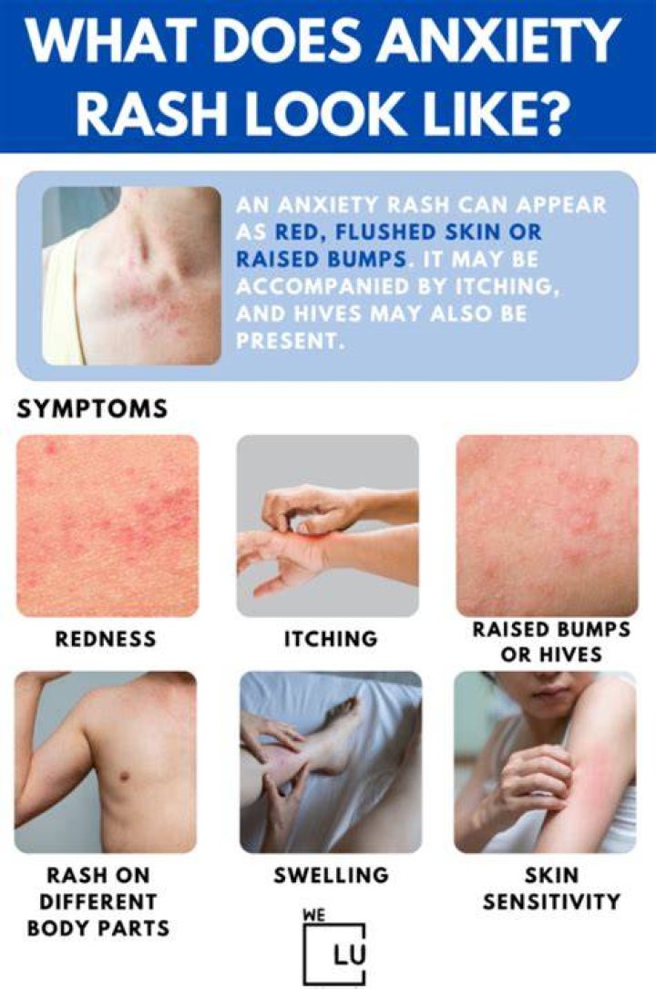 Can anxiety make you feel like your skin is burning?