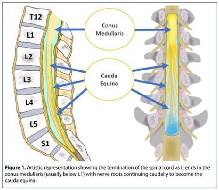 Can sciatica turn into cauda equina?