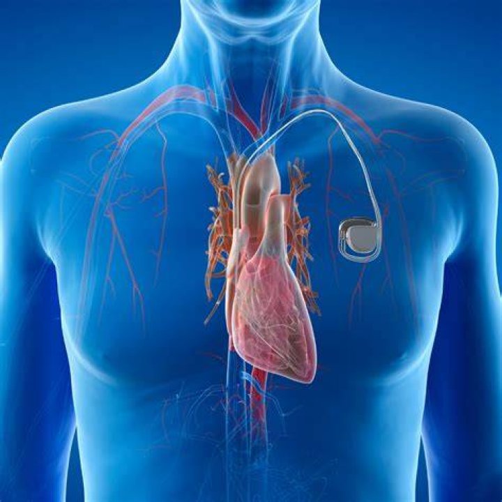 Do all ICD have pacemakers?