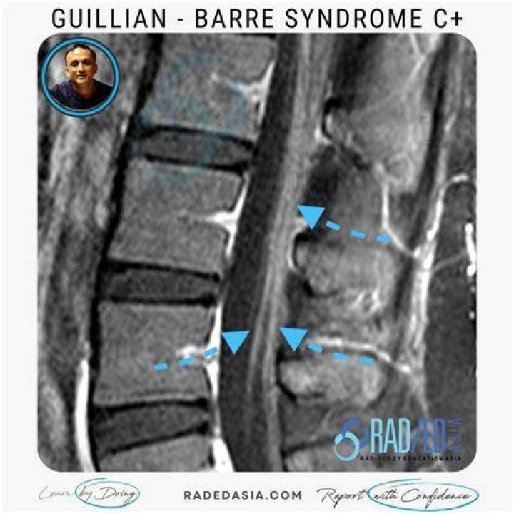 Does Guillain Barre Show on MRI?