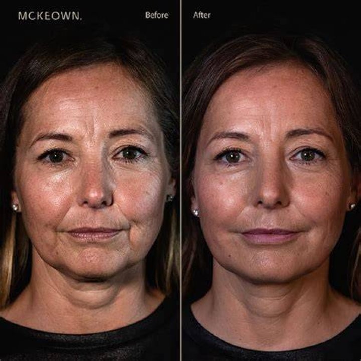 How do celebrities get rid of marionette lines?