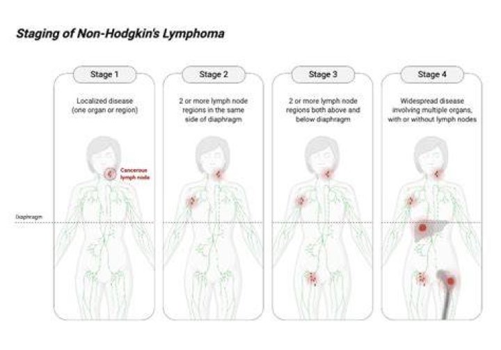 How do you rule out Hodgkin's lymphoma?
