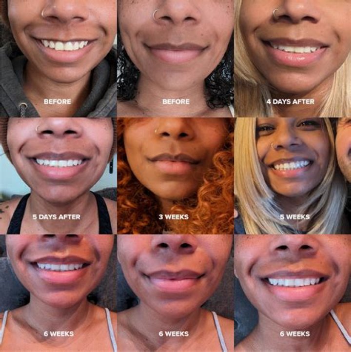 How often do you have to get a lip flip?