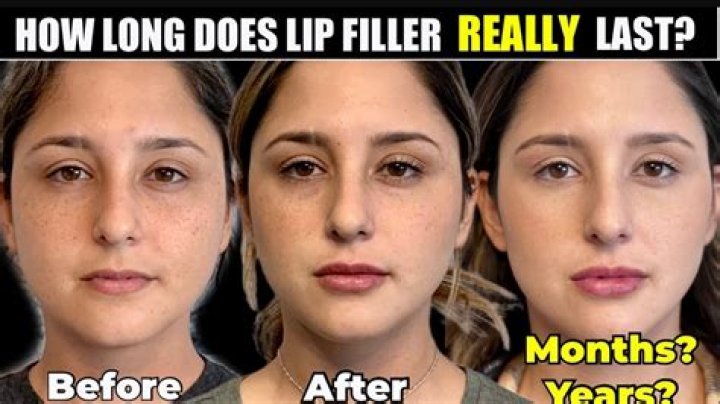 How often should you top up lip fillers?