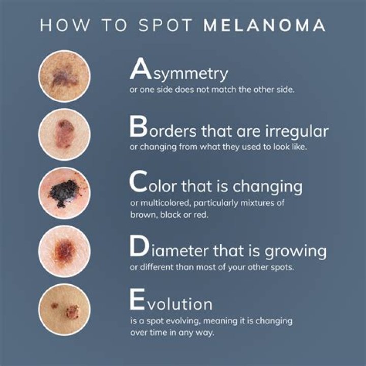 What does a melanoma spot look like?