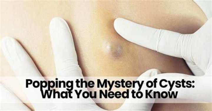 What happens if you keep popping a cyst?