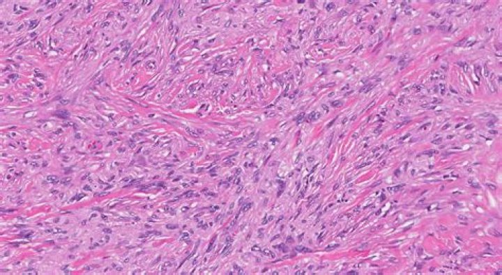 What is cellular fibrous histiocytoma?